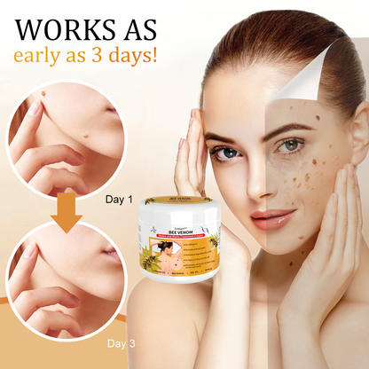 [✨Last day for 50% off✨]🐝🐝🐝 Lenaro™ Bee Venom Mole and Wart Treatment Cream(👨‍⚕AAD RECOMMENDS)